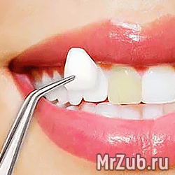 Виниры в Балашихе
